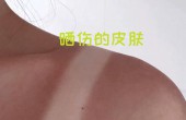 在炎热的夏天里，晒伤之后的皮肤如何急救护理？